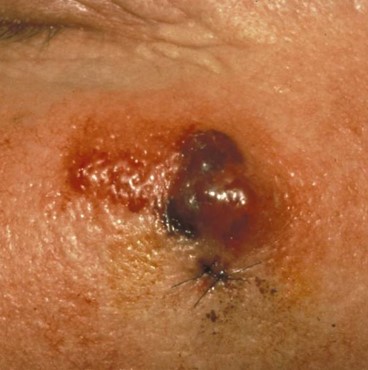 An example of Merkel Cell Carcinoma
